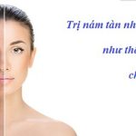 3 bí quyết giảm thâm nám hiệu quả
