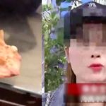 6 tháng sau khi nâng mũi trăm triệu, cô gái trẻ hắt xì ra bông gạc đẫm máu