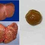 Giảm cân bằng cách ăn hoa quả sấy, người phụ nữ nhập viện vì xơ gan