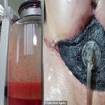 Chi 100 triệu hút mỡ, người phụ nữ đau đớn vì da bụng đen sì, hoại tử