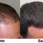 Cải thiện hói đầu, rụng tóc bằng các nguyên liệu tự nhiên tại nhà