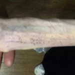 Cánh tay tong teo gây ám ảnh của cô gái trẻ sau 6 tháng giảm cân