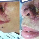 Người phụ nữ Hà Nội bị thối mũi, chảy mủ sau tiêm filler