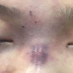 Cô gái ở TP.HCM mù mắt sau khi bạn trai tự tay tiêm filler nâng mũi