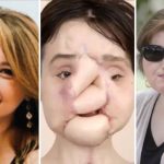 Tự sát không thành, cô gái 23 tuổi trở thành người ghép mặt trẻ nhất thế giới