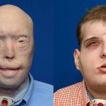 Bi kịch cuộc đời người lính cứu hỏa bị lửa thiêu, 71 lần ghép mặt