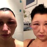 Đầu thiếu nữ bất ngờ to gần gấp đôi sau nhuộm tóc làm đẹp