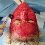 Đi spa đắt đỏ làm đẹp, 2 cô gái không ngờ bị lây nhiễm HIV