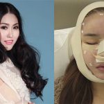 Giật mình hình ảnh phẫu thuật thẩm mỹ băng bó chằng chịt của sao Việt