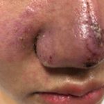 Hà Nội: Thiếu nữ suýt mất mũi, lệch mặt vì làm đẹp