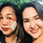 Đôi bạn thân rủ nhau phẫu thuật thẩm mỹ cùng nhận kết đắng