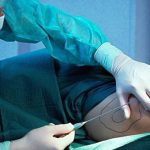 Kết cục bi thảm của vũ công, người phẫu thuật hút mỡ đầu tiên trong lịch sử