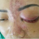 Mù mắt khi tiêm filler: Phớt lờ cảnh báo, hậu quả tức thì