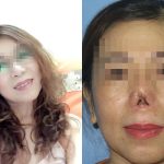 Mũi quý bà Sài Gòn cụt lủn sau nâng mũi tại thẩm mỹ viện