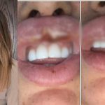 Cô gái suýt phải cắt bỏ môi vì theo đuổi trào lưu tiêm botox