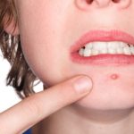 5 loại thực phẩm khiến tình trạng mụn trứng cá thêm nặng