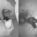 Ngực người phụ nữ Hà Nội phình to gấp đôi sau tiêm filler