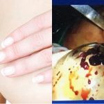 Ngực nữ doanh nhân Việt 33 tuổi sưng to như muốn nổ tung sau thẩm mĩ