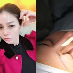 Sau vụ Lệ Quyên, nên nâng mũi bằng sụn giả hay sụn tự thân?