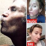 Thực hư việc uống và bôi nước tiểu để giảm cân và trị mụn