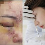 Tiêm filler nâng mũi, cô gái 27 tuổi mù 1 mắt