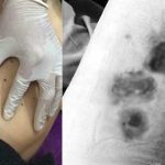 Cô gái 28 tuổi hoại tử, suýt phải cắt cụt hai chân vì tiêm tan mỡ