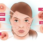 Trị mụn tại nhà đơn giản, hiệu quả chỉ mất vài phút mỗi ngày