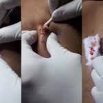 Video bác sĩ vật lộn nặn mụn nằm im 10 năm ở Hà Nội lên báo Tây