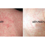 ban-soi-va-sot-phat-ban-phan-biet-nhan-biet-va-cham-soc-dung-cach