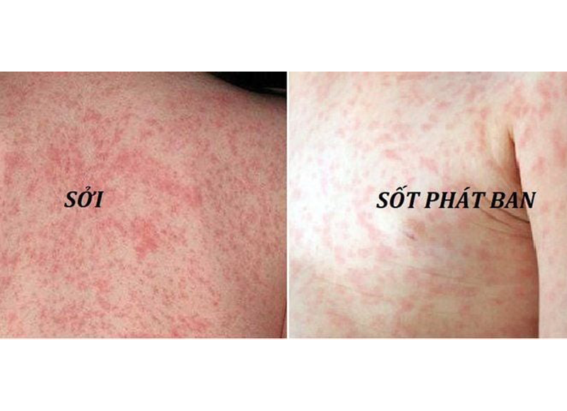 ban-soi-va-sot-phat-ban-phan-biet-nhan-biet-va-cham-soc-dung-cach