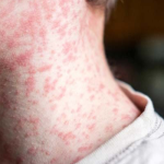 benh-soi-hieu-ro-de-phong-tranh-va-dieu-tri-hieu-qua