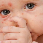 benh-soi-o-tre-em-tam-quan-trong-va-buc-tranh-tong-quan