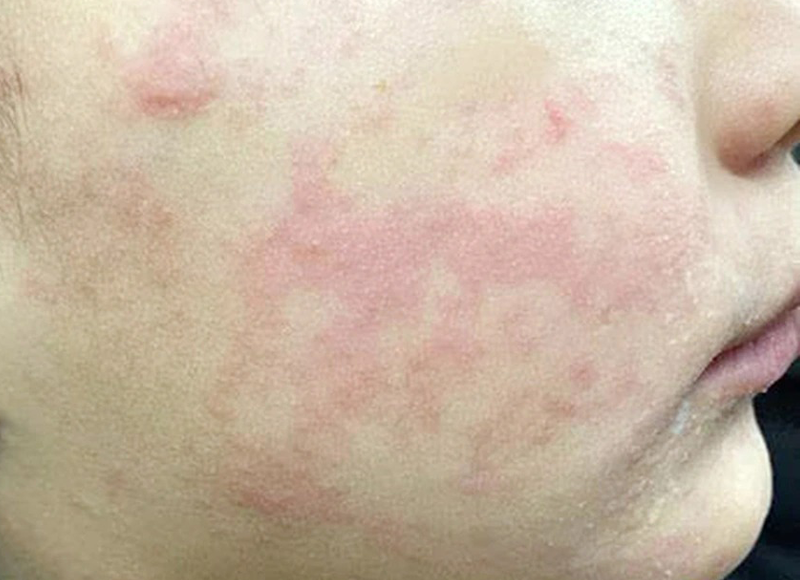 tat-tan-tat-ve-ban-soi-nhan-biet-nguyen-nhan-va-cach-phong-tranh-hieu-qua